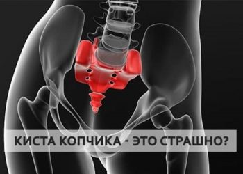 киста копчика