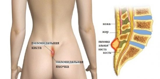 киста копчика симптомы и лечение