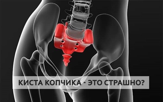 киста копчика